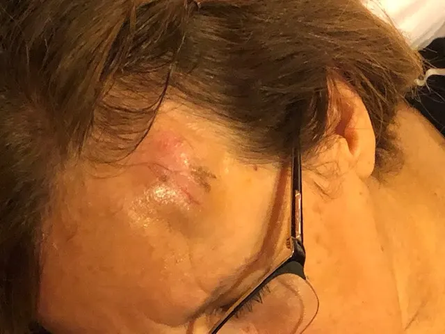 Denise went down the stairs head first and banged her side of her head on a metal pipe. It was a nasty fall as I described above. Lots of places are hurting. But this was the worst.